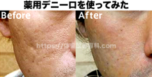 薬用デニーロ使用後