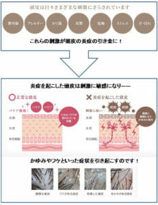 頭皮のかゆみの原因